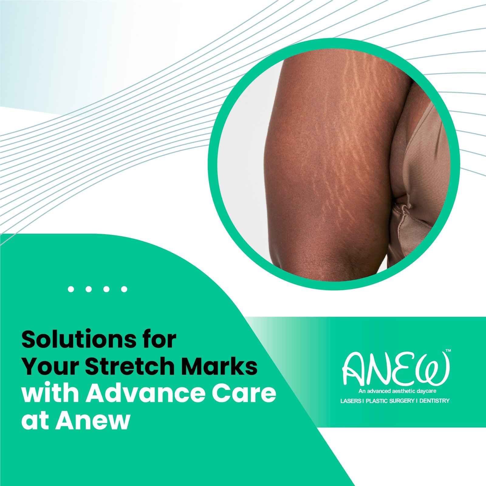 Stretch Marks Treatment In Bangalore